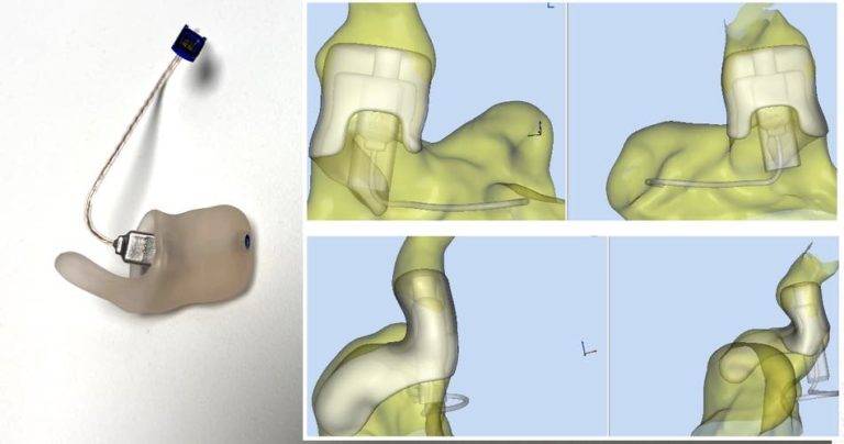 Which Hearing Aid Fits a Small Ear Canal? – improvehearingaids.com